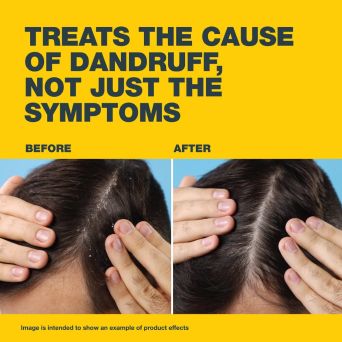 Before and after using Nizoral Anti-Dandruff Shampoo on a flaky scalp