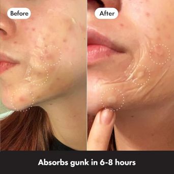 Before and after results using XL hydrocolloid patches for a cheek cluster breakout treatment in 6-8 hours.